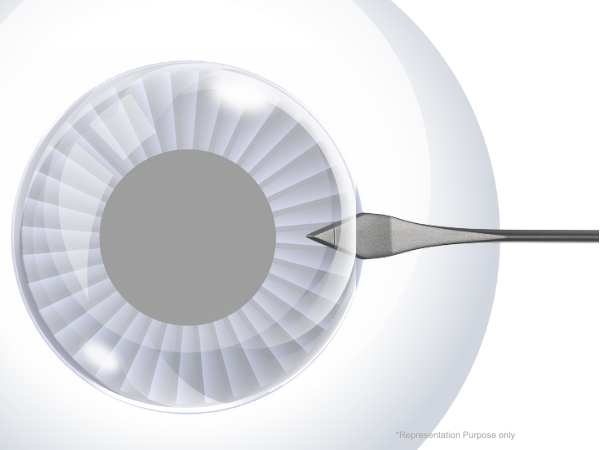Acucut Slit Blade & Keratome Blades (Double)