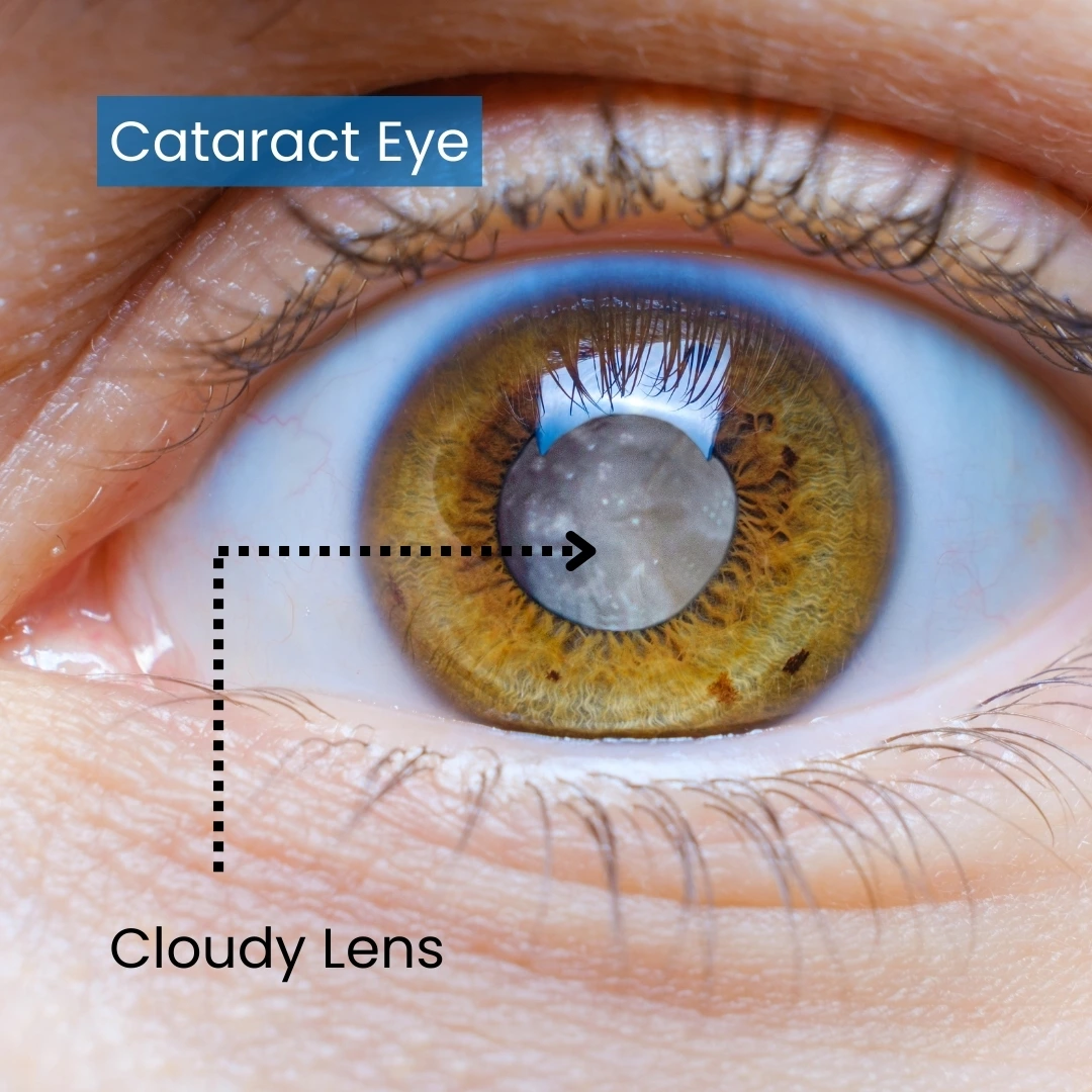 Types of Cataract