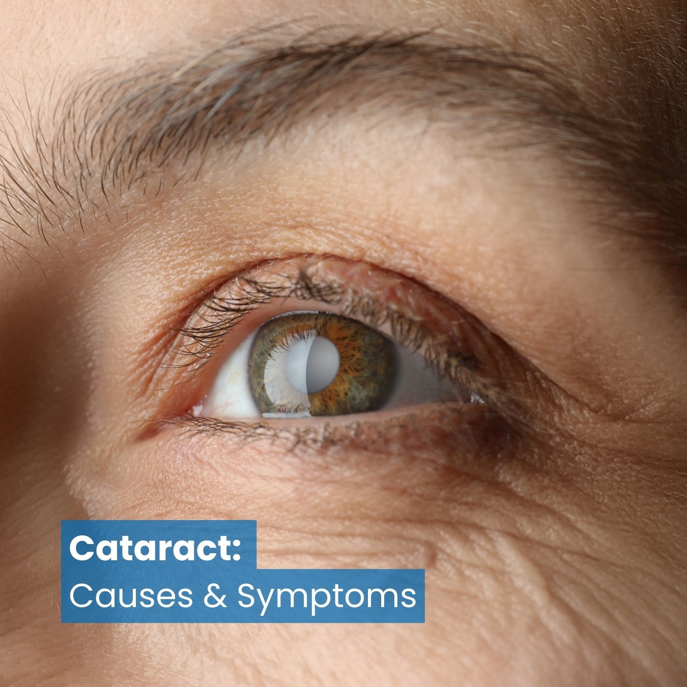 Cataract: Causes & Symptoms