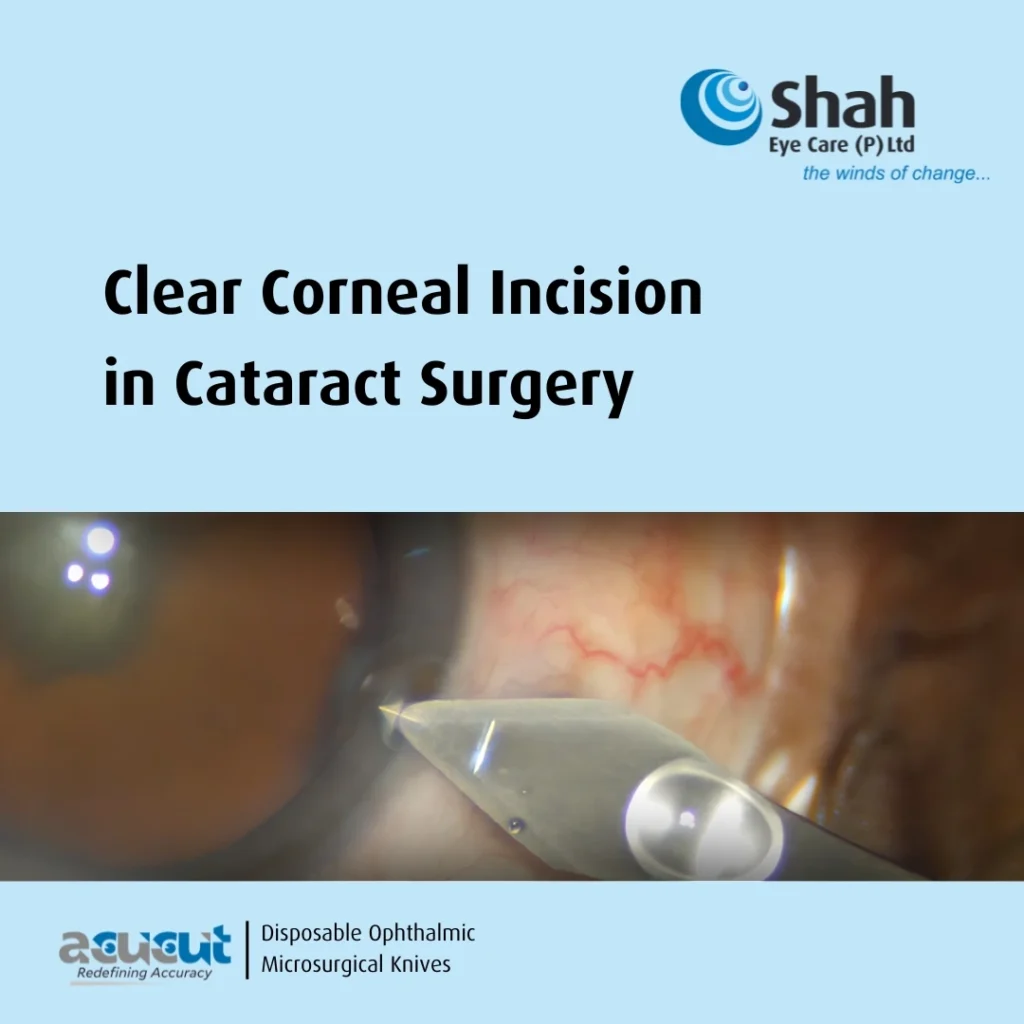 CCI in cataract surgery